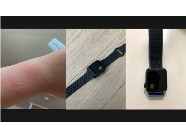 Apple Watch SE sinh nhiệt gây bỏng tay người dùng