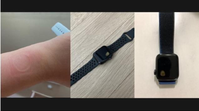Apple Watch SE sinh nhiệt gây bỏng tay người dùng